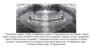 Normal Anatomic Landmarks On Panoramic Radiograph Dental Care