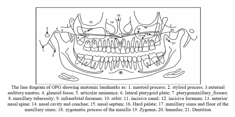 Normal Anatomic Landmarks On Panoramic Radiograph - Dental Care