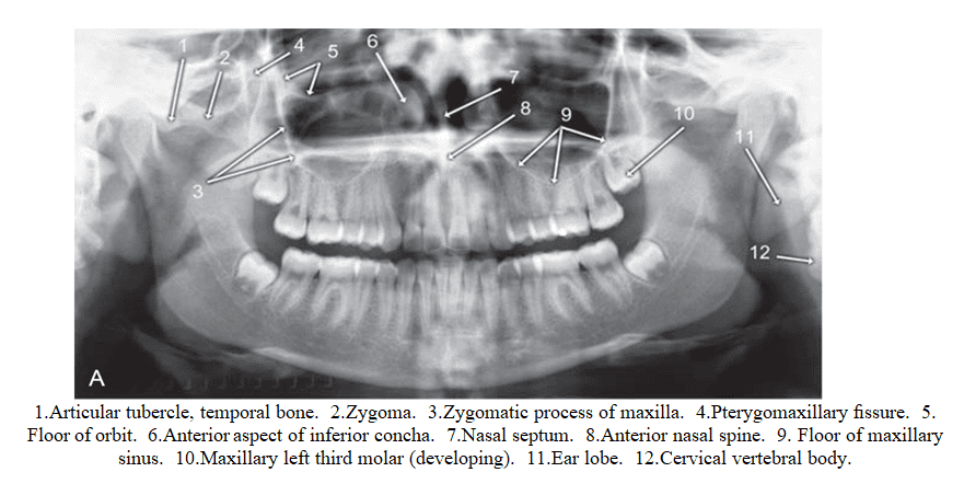 Zygomatic Process Of Maxilla Radiograph