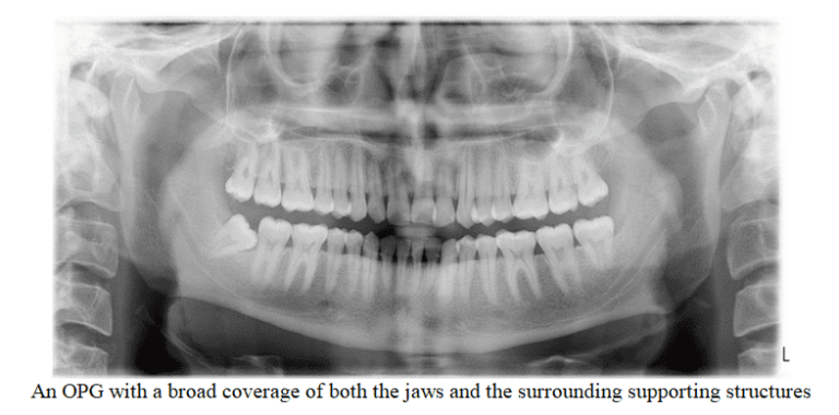 Normal Anatomic Landmarks On Panoramic Radiograph Dental Care