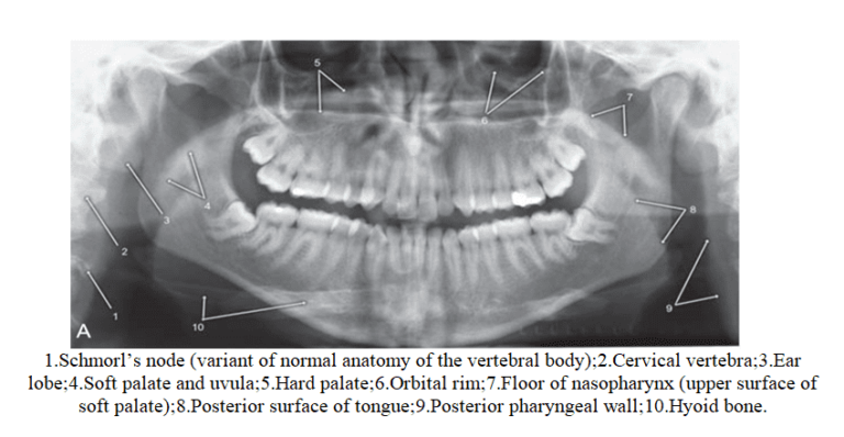 Normal Anatomic Landmarks On Panoramic Radiograph - Dental Care