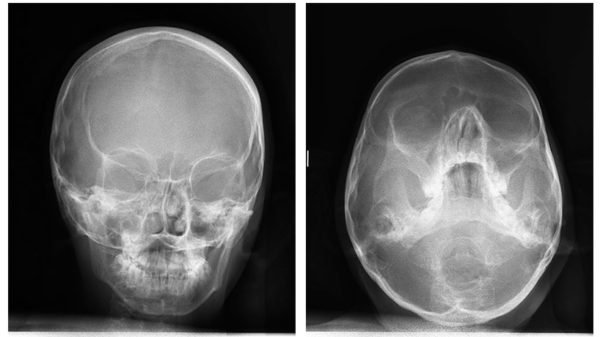 The Extra-oral x-ray films - Dental Care