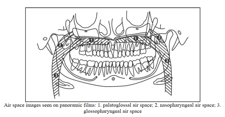 Normal Anatomic Landmarks On Panoramic Radiograph - Dental Care